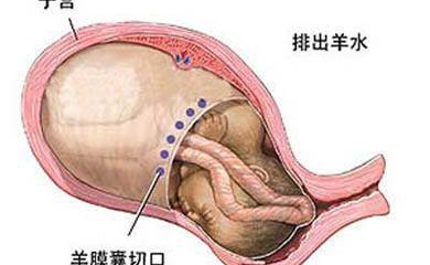 分娩并发症