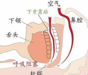 中枢性睡眠呼吸中止症候群