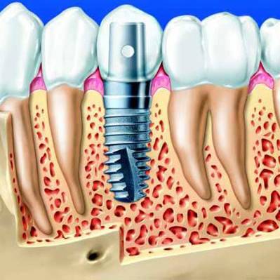 种植牙（生物医学工程领域--人工器官材料）