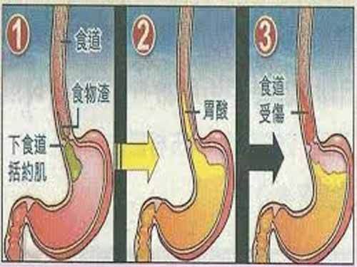 胃反酸