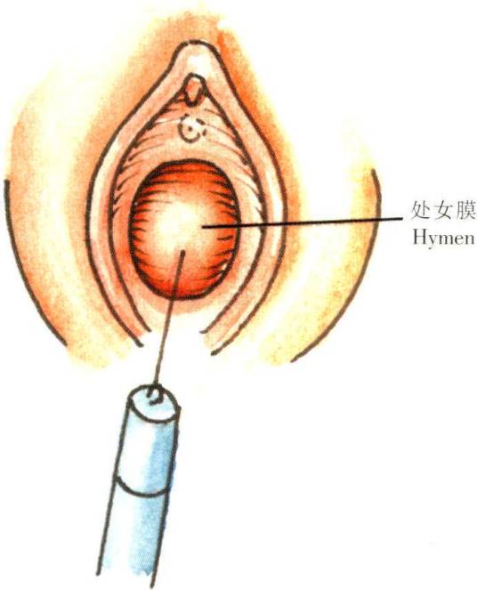 处女膜封闭