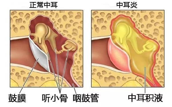 中耳炎忌吃什么