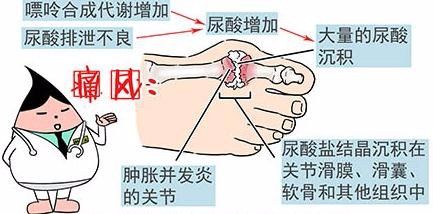 痛风快速止痛的方法