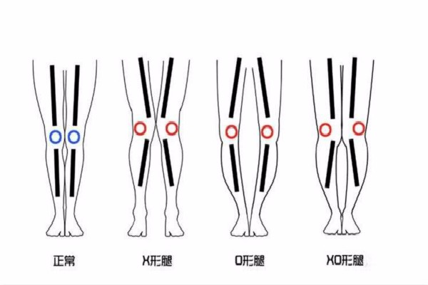 怎么才算O型腿？哪些比较有名的明星是O型腿？