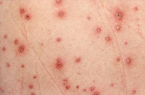 请问小孩长水痘的图片症状是哪些？