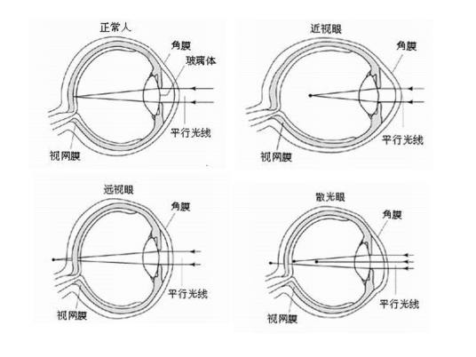 关于预防近视的资料