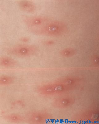 请问小孩长水痘的图片症状是哪些？