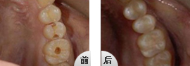 补一颗牙齿需要多少钱啊